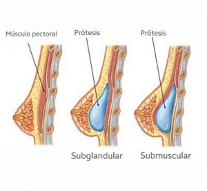 plano protesis mamarias