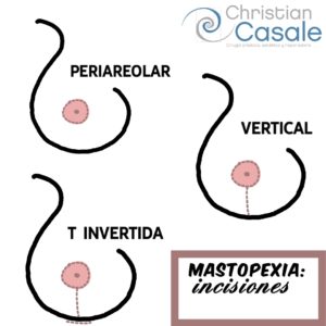 Cicatriz de mastopexia
