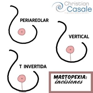 Técnica y resultados de la Mastopexia