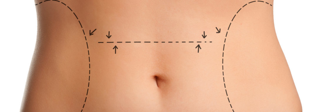 abdominoplastia