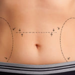 abdominoplastia
