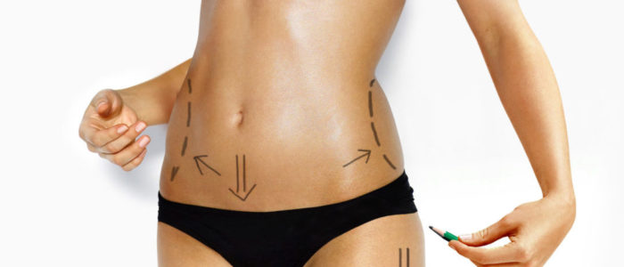 Abdominoplastia en Tenerife